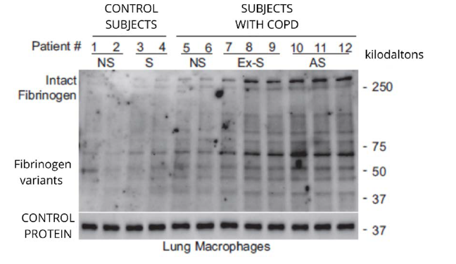 Lab results reflecting high fibrinogen concentrations in macrophages from subjects with COPD.